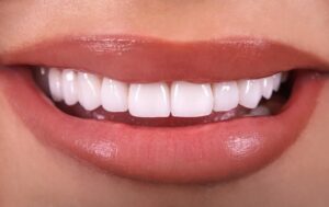 Veneer Dentist