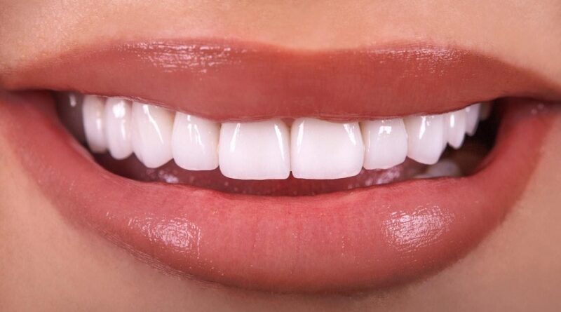 Veneer Dentist